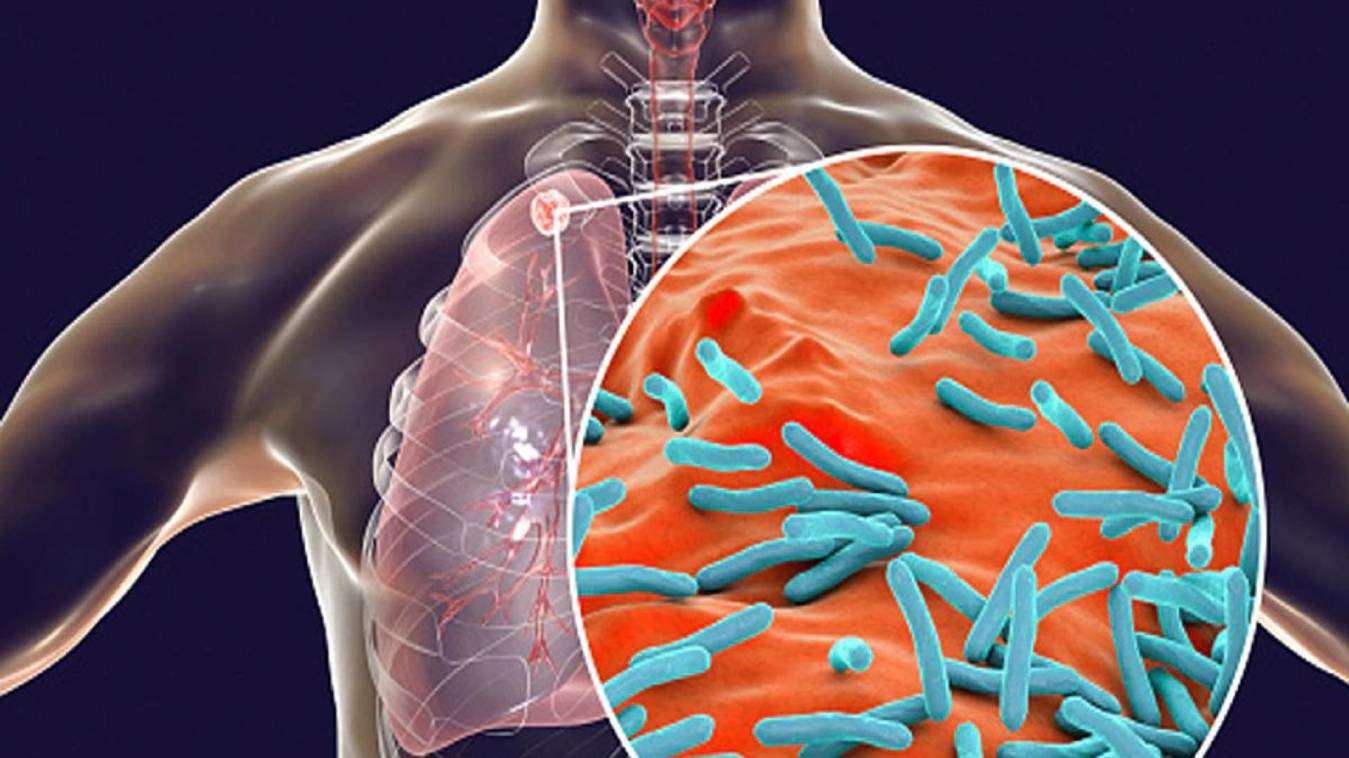 टीबी के खात्मे को हर महीने ढूंढे जाएंगे मरीज