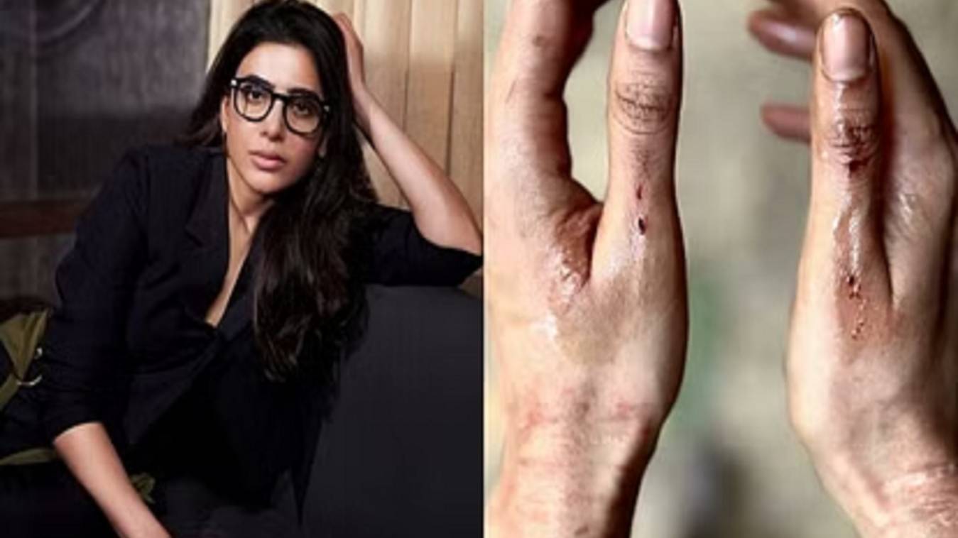 Samantha Prabhu: शूटिंग के दौरान घायल हुईं ऊ अंटावा गर्ल 