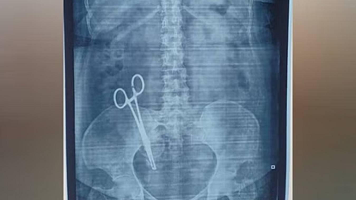 17 साल पहले निजी अस्पताल की डॉक्टर ने महिला के पेट में छोड़ी कैंची, एक्सरे ने उजागर की डॉक्टरों की लापरवाही,  रिपोर्ट देख उड़े होश