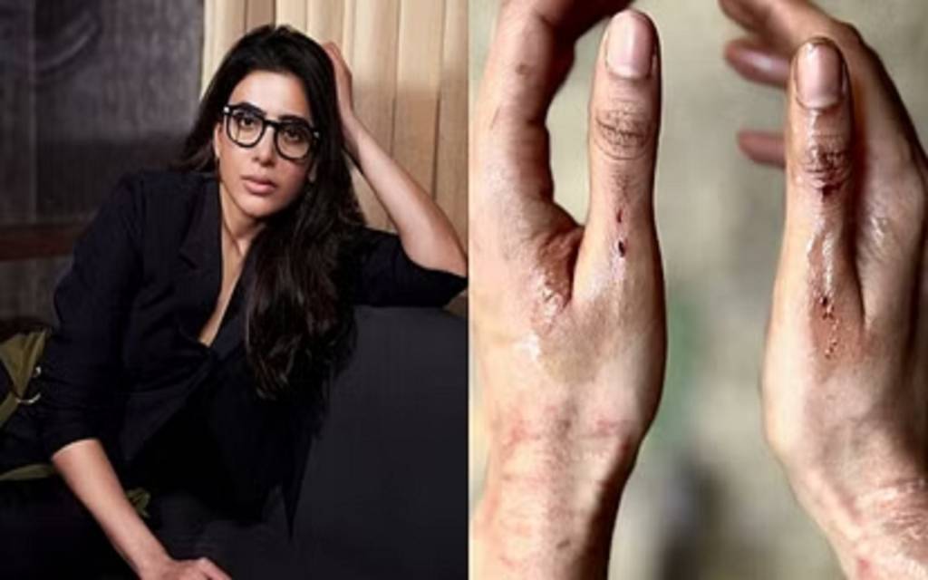 Samantha Prabhu: शूटिंग के दौरान घायल हुईं ऊ अंटावा गर्ल