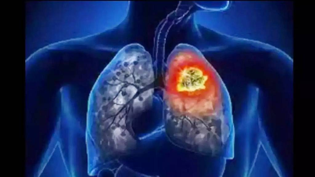 वर्ल्ड लंग कैंसर दिवस: सिगरेट से ज्यादा प्रदूषण से खराब हो रहे फेफड़े
